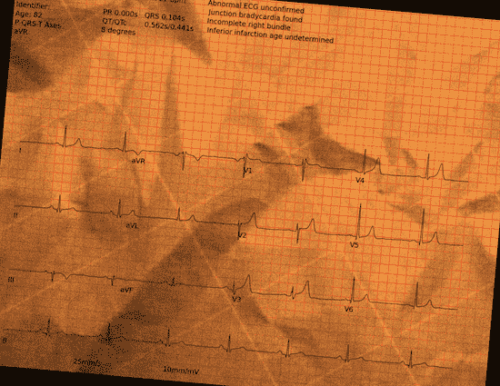 Normal ECG — PTB-XL