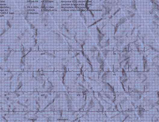 Normal ECG — PTB-XL