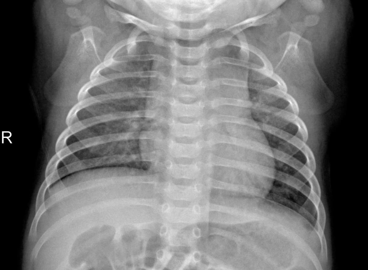 Radiografia Normal — NIH Chest X-ray14