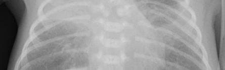Pneumonia — NIH Chest X-ray14