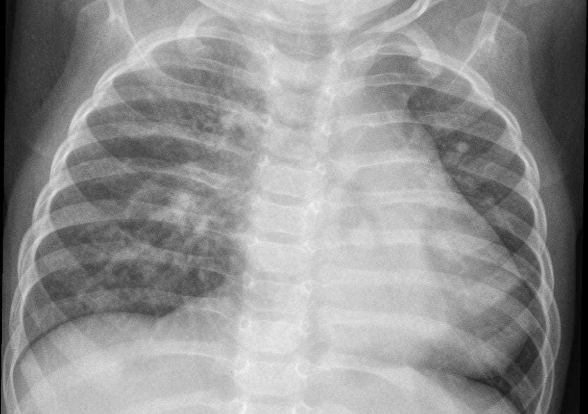 Pneumonia — NIH Chest X-ray14