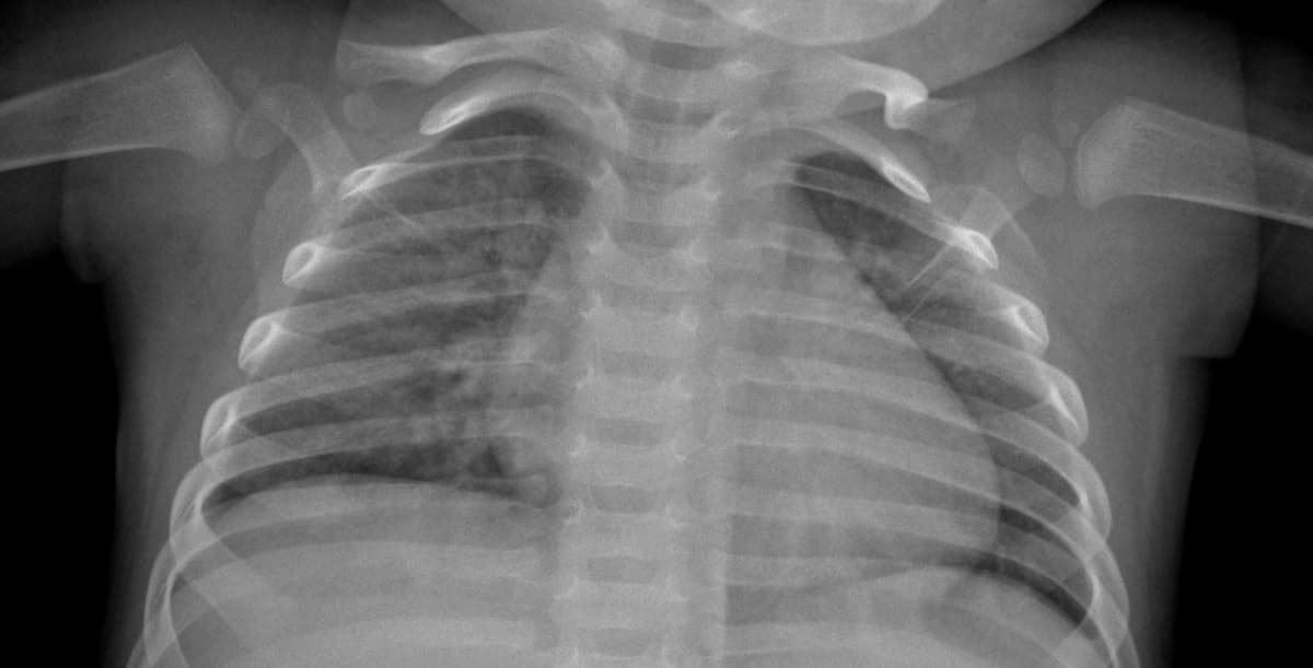 Pneumonia — NIH Chest X-ray14