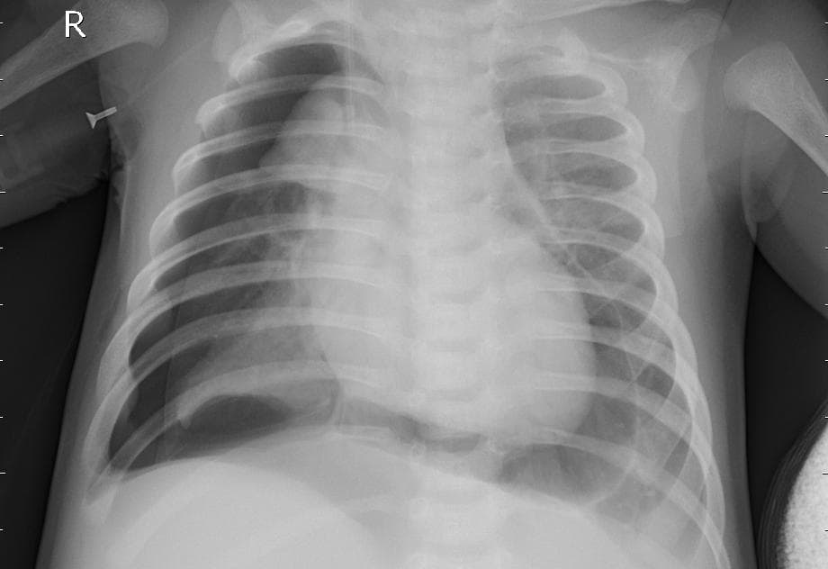 Pneumonia — NIH Chest X-ray14