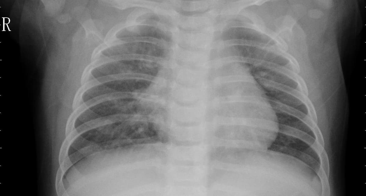 Pneumonia — NIH Chest X-ray14