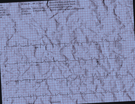 Normal ECG — PTB-XL