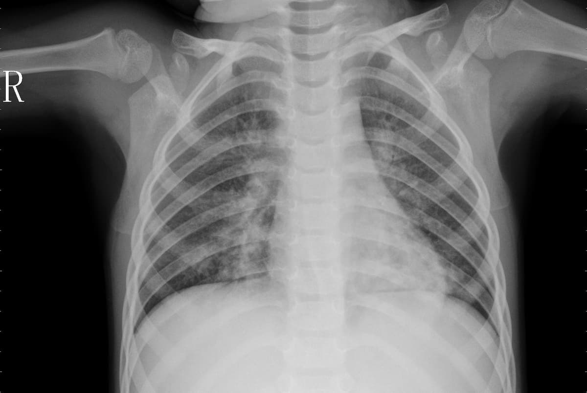 Pneumonia — NIH Chest X-ray14