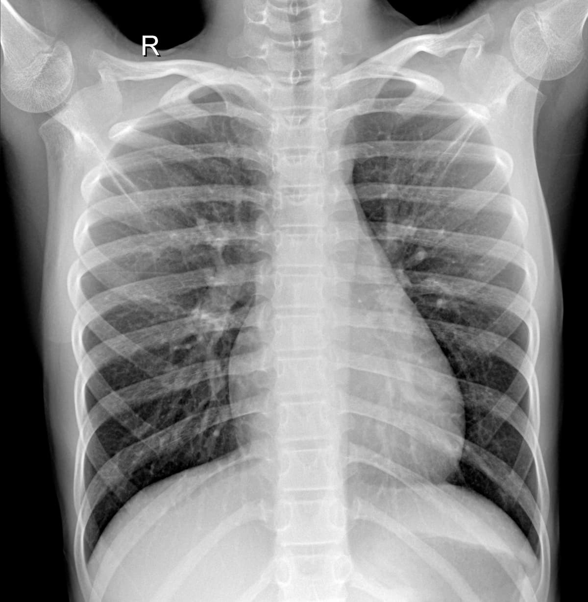 Radiografia Normal — NIH Chest X-ray14