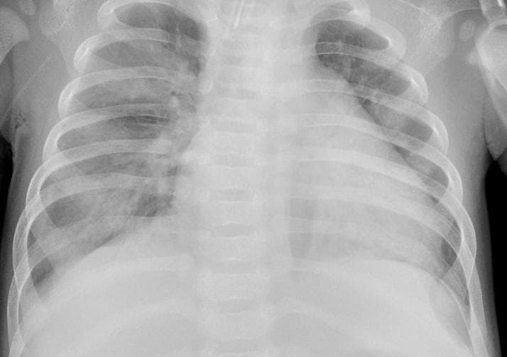 Pneumonia — NIH Chest X-ray14