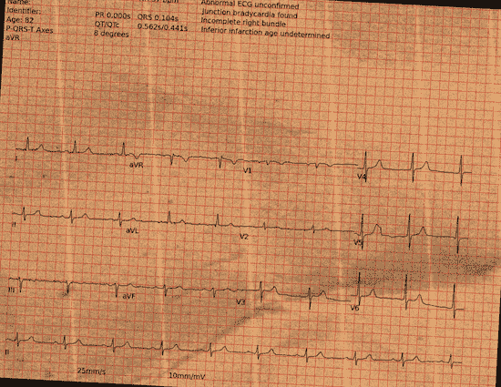 Normal ECG — PTB-XL