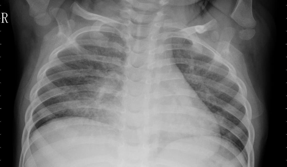 Pneumonia — NIH Chest X-ray14
