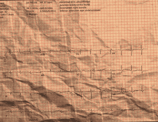 Normal ECG — PTB-XL