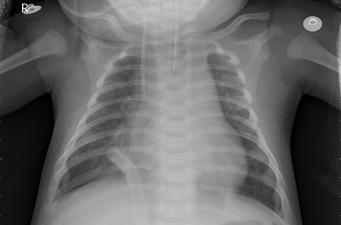 Pneumonia — NIH Chest X-ray14