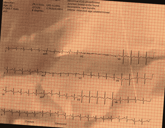 Normal ECG — PTB-XL