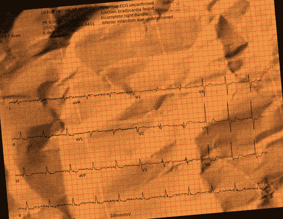 Normal ECG — PTB-XL