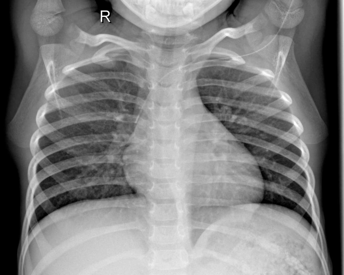 Radiografia Normal — NIH Chest X-ray14