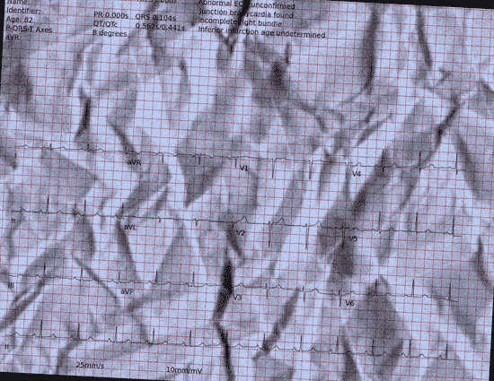 Normal ECG — PTB-XL