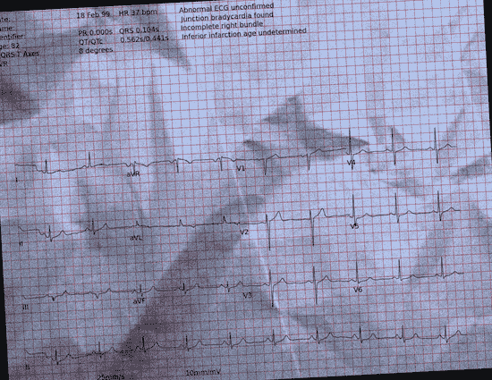 Normal ECG — PTB-XL