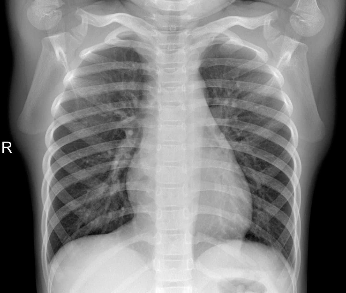 Radiografia Normal — NIH Chest X-ray14