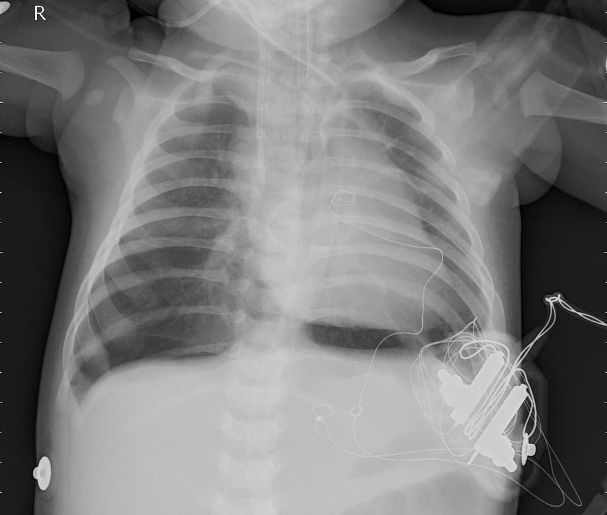 Pneumonia — NIH Chest X-ray14