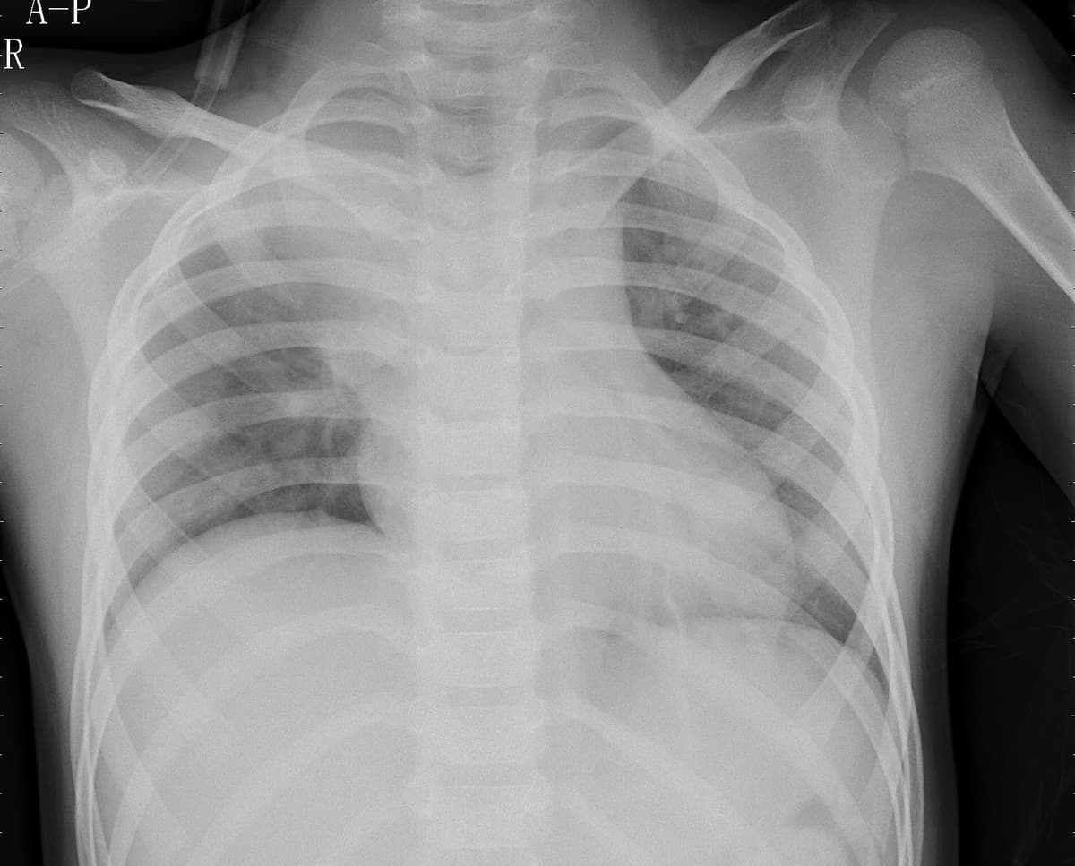 Pneumonia — NIH Chest X-ray14