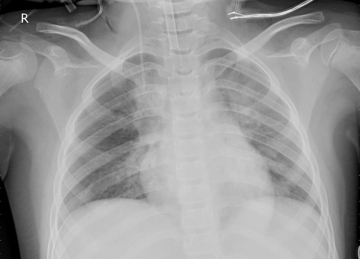 Pneumonia — NIH Chest X-ray14