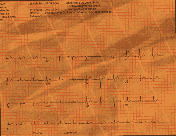 Normal ECG — PTB-XL
