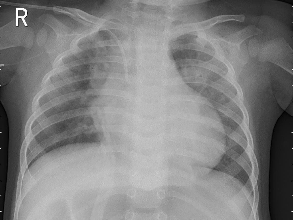 Pneumonia — NIH Chest X-ray14