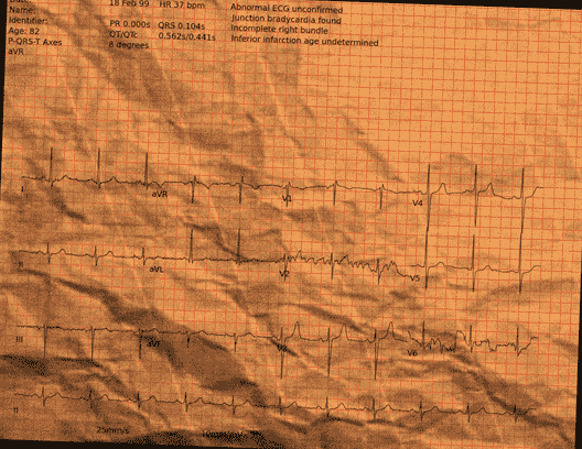 Normal ECG — PTB-XL