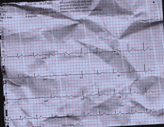 Normal ECG — PTB-XL