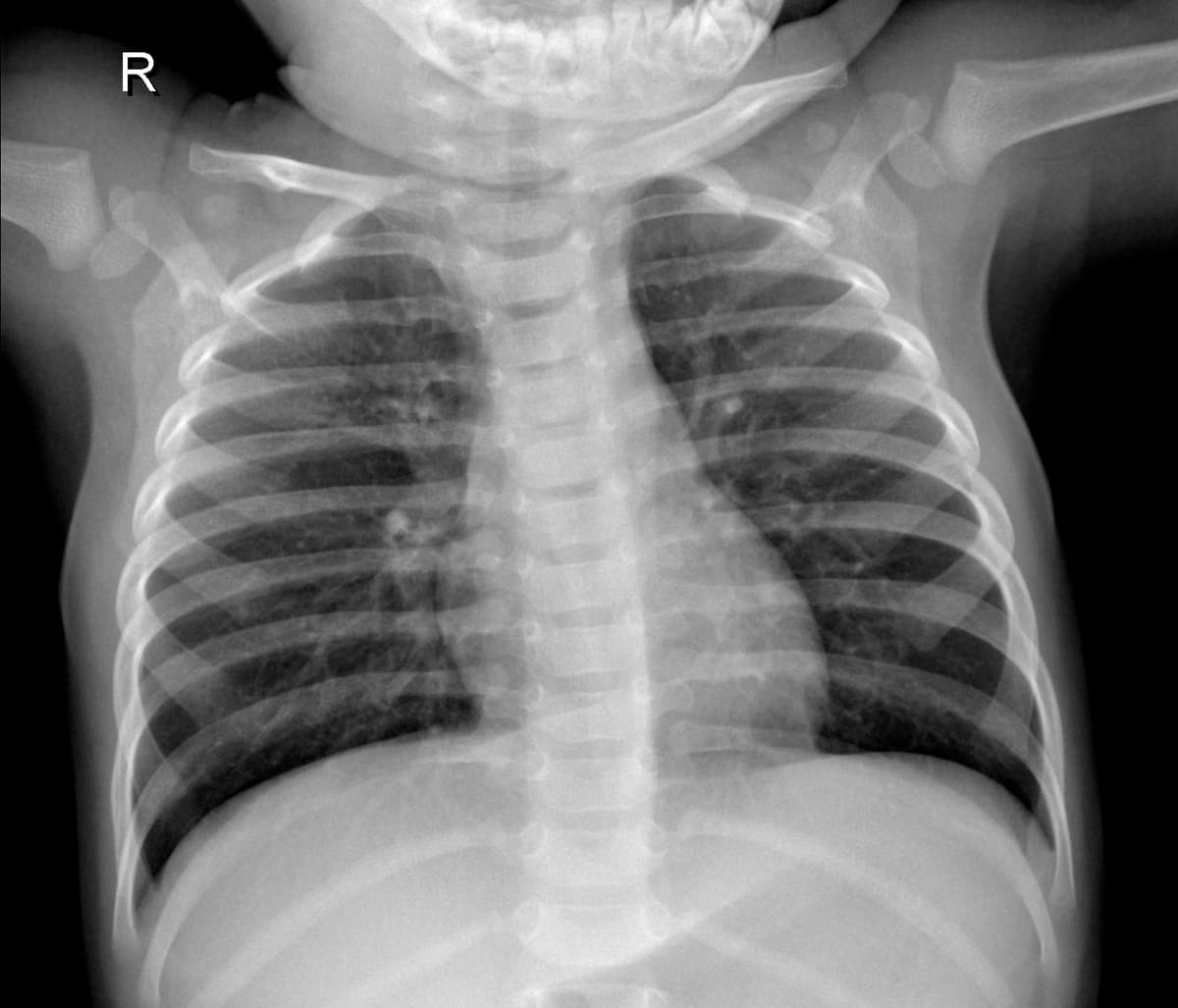Radiografia Normal — NIH Chest X-ray14