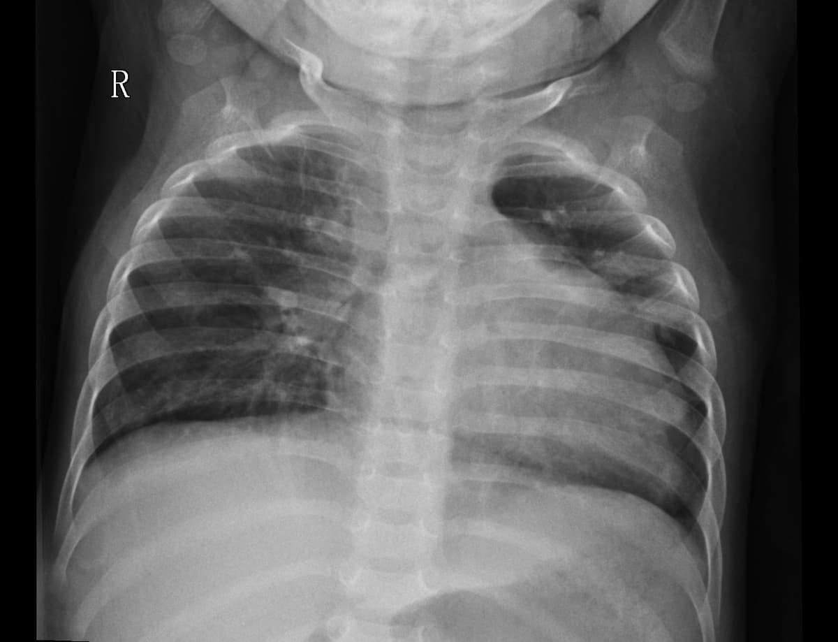 Pneumonia — NIH Chest X-ray14