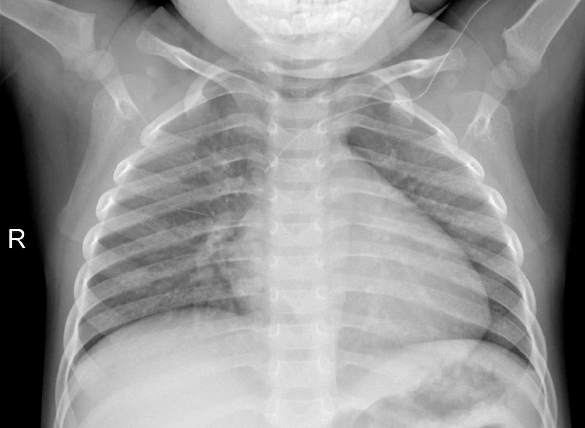 Radiografia Normal — NIH Chest X-ray14