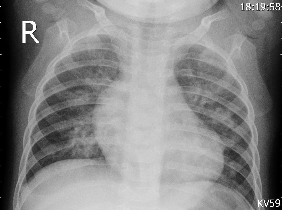 Pneumonia — NIH Chest X-ray14