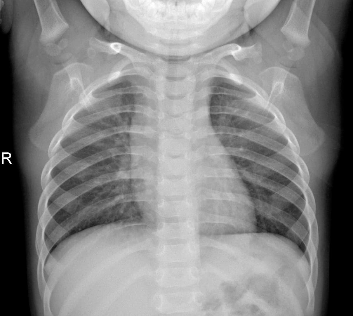 Radiografia Normal — NIH Chest X-ray14
