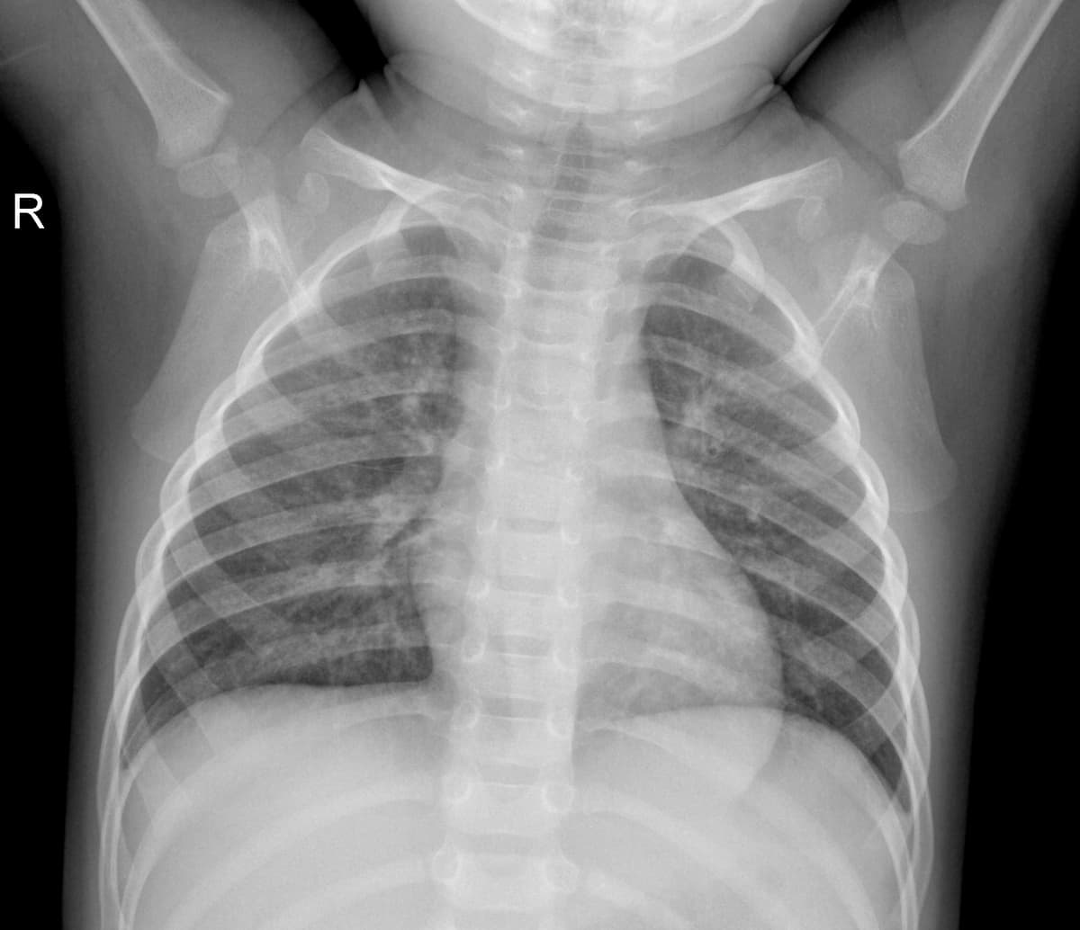 Radiografia Normal — NIH Chest X-ray14