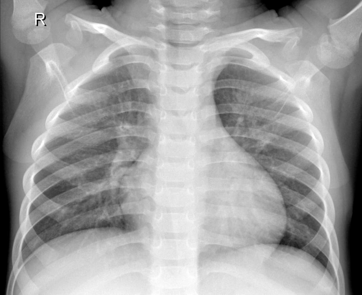 Radiografia Normal — NIH Chest X-ray14