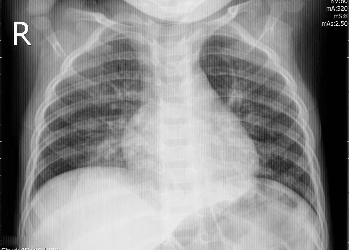 Pneumonia — NIH Chest X-ray14
