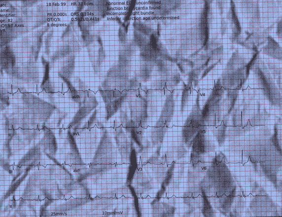 Normal ECG — PTB-XL