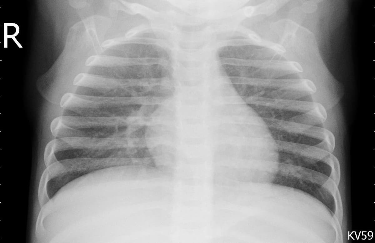 Pneumonia — NIH Chest X-ray14