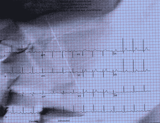 Normal ECG — PTB-XL