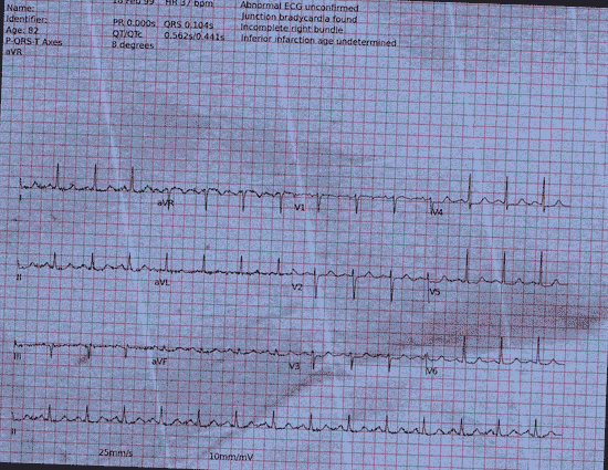 Normal ECG — PTB-XL