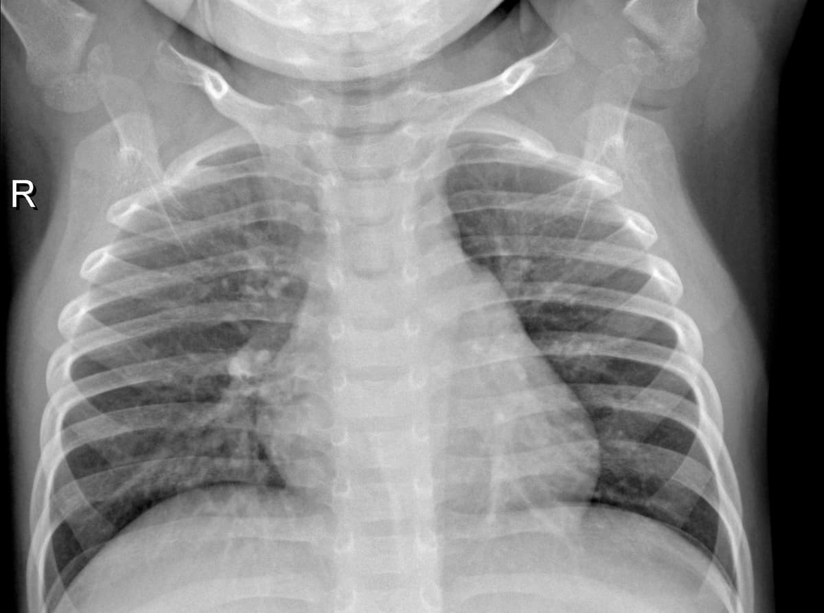 Radiografia Normal — NIH Chest X-ray14