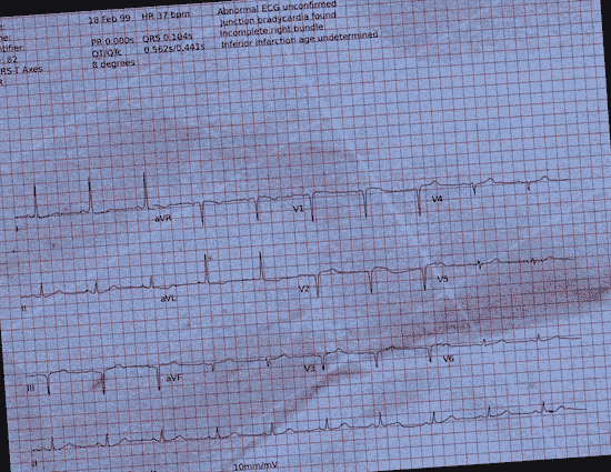 Normal ECG — PTB-XL