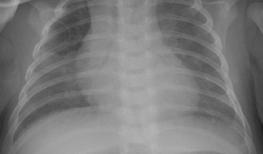 Pneumonia — NIH Chest X-ray14