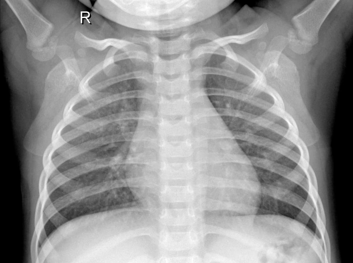 Radiografia Normal — NIH Chest X-ray14