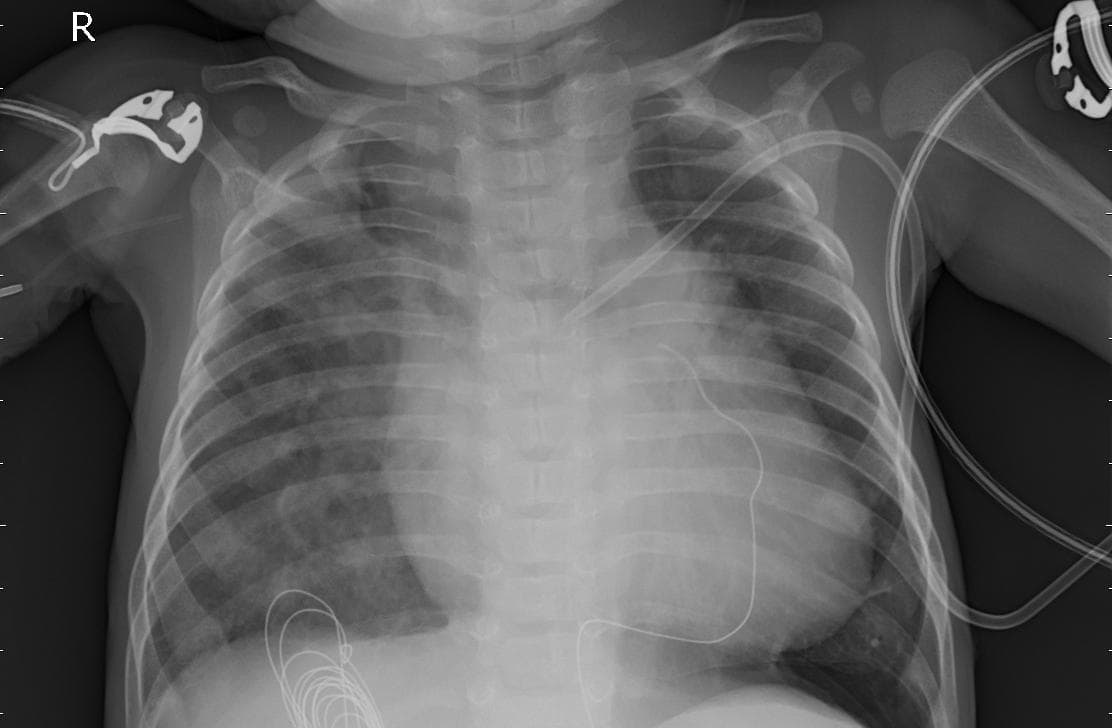 Pneumonia — NIH Chest X-ray14