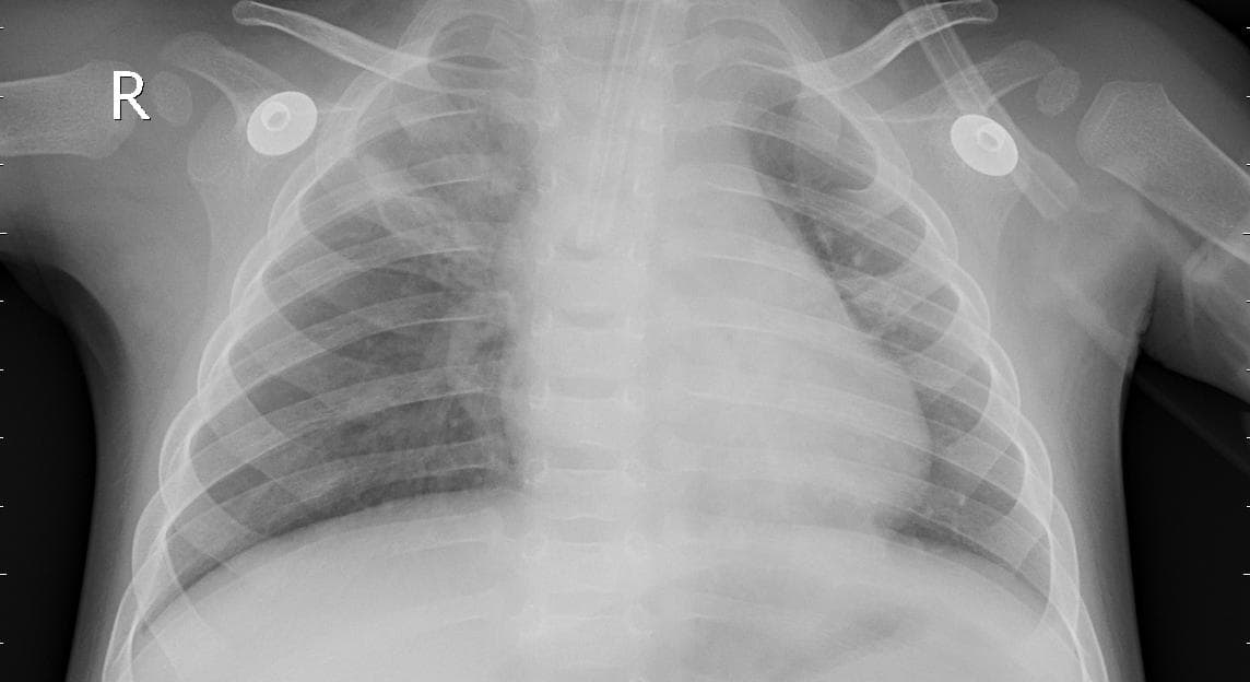 Pneumonia — NIH Chest X-ray14