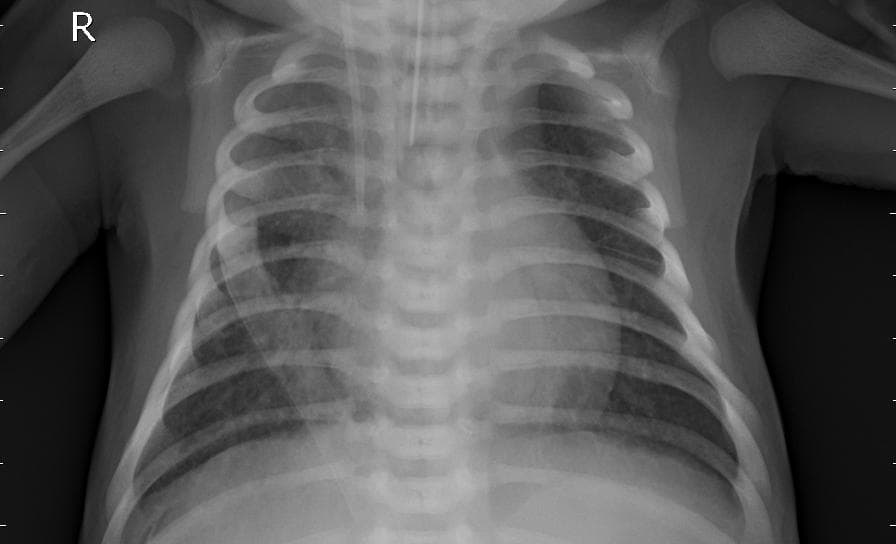 Pneumonia — NIH Chest X-ray14