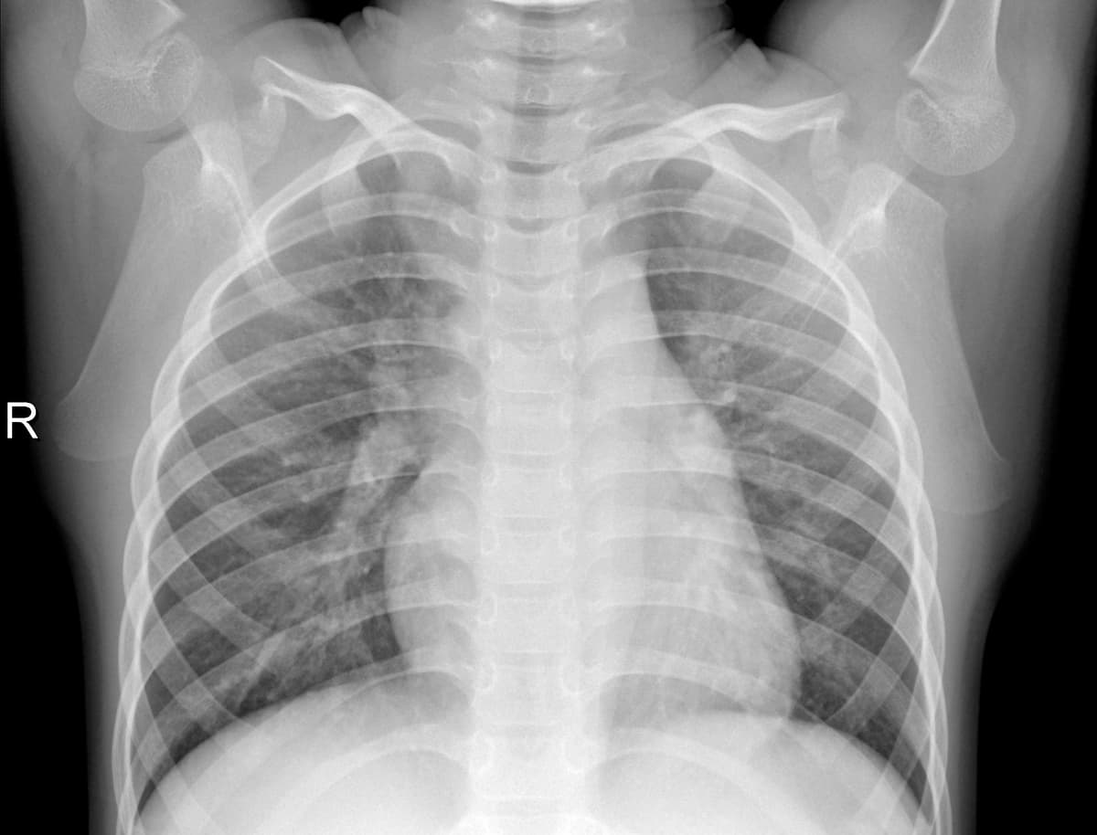 Radiografia Normal — NIH Chest X-ray14