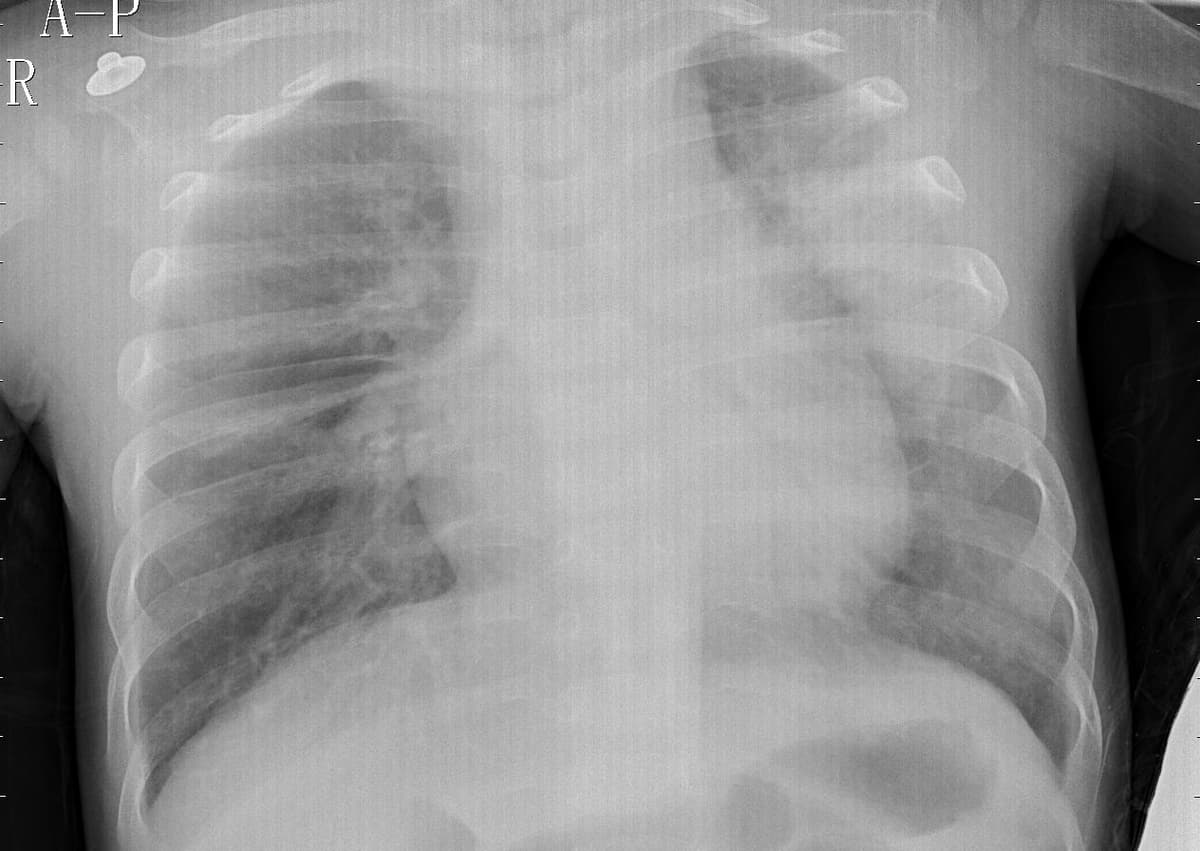Pneumonia — NIH Chest X-ray14